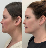 Buy an IPL Package of 3 & receive a Free Deluxe Facial with Neck & Chest Brightening Treatment ($249 value)