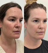 Buy an IPL Package of 3 & receive a Free Deluxe Facial with Neck & Chest Brightening Treatment ($249 value)